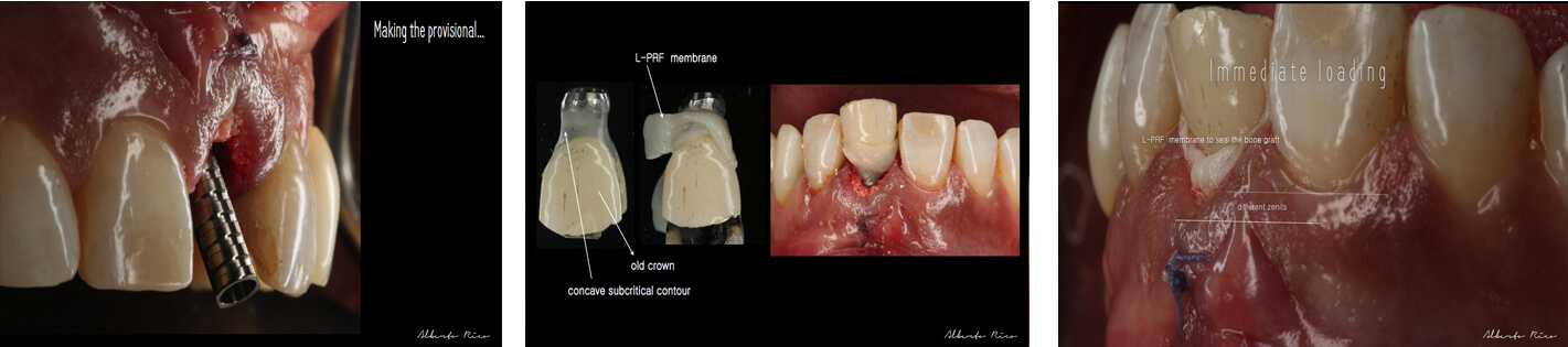 Caso clínico implante dental parte 3