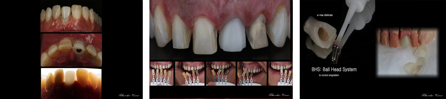 Caso clínico implante dental parte 5