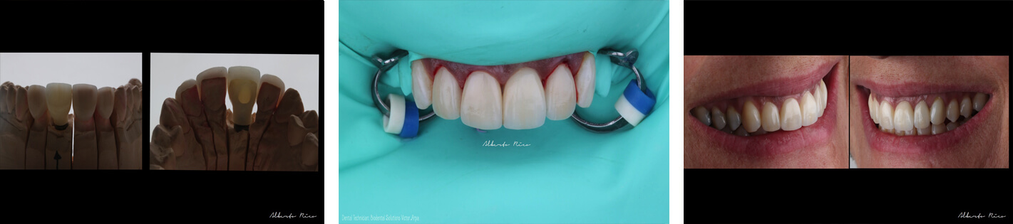 Caso clínico implante dental parte 6