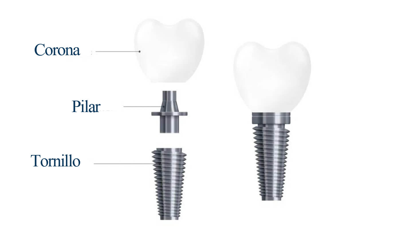 Partes que forman un implante dental